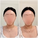 코리아세븐 대구종로2가점 | [대구 윤곽관] 대구리프팅전문 제이라인코리아 무통리프팅 후기, 대구피부관리 추천