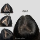 디그노스칼프 | 가르마두피문신 디그노스칼프 회차별 후기 알려드릴께요