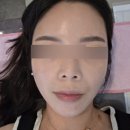 율한의원 | [홍대 해율한의원] 오름테라피 여드름흉터 관리 2회차 솔직후기