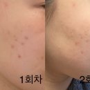 피코토닝 2회차 후기(미세한 변화 발견)
