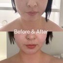 코리아세븐 분당정자본점 | 정자에스테틱 수내동피부관리 추천! 가인미가 분당 얼굴축소 후기