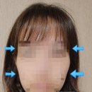 언광반점 | [4]월치료 1회차 비발치 클리피씨 교정일기_와이어 교체, 어금니에 부착, 땅콩형얼굴(?)