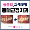홍덴탈플러스 | 홍대 교정치과 에서 돌출입을 발치없이 성공한 사례^^