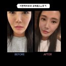 3 | 서현역피부과 쥬베룩3cc후기 , 속건조해결 !