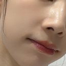 깐달걀피부 만들기 홍대피부과 리쥬란힐러 후기