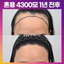 [30대 여자 매우 넓은 M자이마 헤어라인 모발이식] 혼용 4300모 1년 후기 (모엠의원/헤어라인/전지훈원장) 이미지