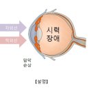 설맹[Snow blindness]눈질환 이미지