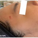 이제이메디컬 | [여드름색소침착관리] 경성대여드름피부관리 경성대여드름흉터관리