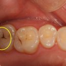 중동갤러리치과의원 | 부천시 중동 치과, 충치 있는데 교정 먼저 해도 될까요? <질문답변>