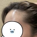 헤어라인모발이식 2주차 후기, 통증 없이 벌써 만족하는 이유