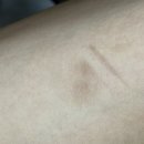 미보약국 | 고데기 2도 화상 초기 미보 화상연고 후기