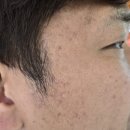 부천리더스피부과의원 네이버블로그