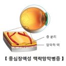 중심장액성 맥락망막병증[Central Serous ChorioRetinopathy]눈질환 이미지