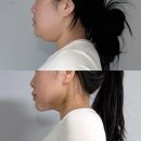 좋은솜씨성형외과의원 | 강남 이중턱살제거 내돈내산 일주일 변화 후기 리모성형외과