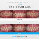 일광치과의원 | [기장일광치과] 아이의 덧니로 부분교정 고민 중이시라면
