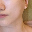 사하구작은얼굴관리 솔에스테틱 여름철 피부고민해결 에어 플라즈마 후기