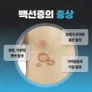 백선세탁 이미지