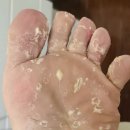 군내약국 | 라미실 원스 가격 발가락 사이 무좀 백선균 퇴치 후기