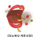 당뇨병성 케톤산증 원인1형 당뇨 합병증 이미지