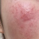 대나무한의원 | 요즘 스킨케어 방법과 인생템 제품(피부염 겪고 주사 안면홍조 열감 겪은 민감성 수부지)