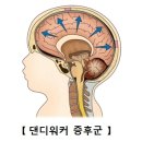 댄디워커 증후군9Dandy-Walker syndrome) 소아청소년질환, 유전질환이란? 이미지