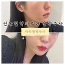 바라던 핏 | 신논현역피부과 바라던핏 얼굴지방분해주사 효과 및 후기