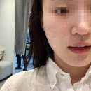 강남 기미피부과 코어레이저 후기 | 본식 4개월 전 색소침착 피부관리 시작