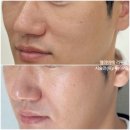 논현1-107 | 신논현피부과 전문의 엘라비에 리투오 효과 가격 스킨부스터 후기