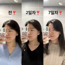 중앙로5 | 대구 중앙로 피부과 쿨소닉 리프팅 내돈내산 솔직 후기