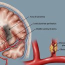 지앤이알파돔메디컬센터 의원 | 뇌경색 전조증상, 골든타임 지키는 판독의 정확성이 핵심인 이유