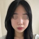 가미성형외과의원 | 눈재수술(비절개눈매교정) 바나나성형외과 / 코수술 눈수술 쌍수 쌍커풀수술 강남성형외과