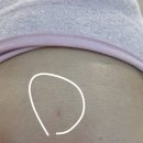 온마음연세의원 | 원주 연세라움의원 혁신도시 홍조 레이저 치료 온다리프팅 후기 가격