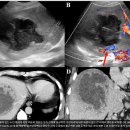 간내 낭포성 병변 감별질환 이미지