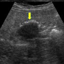 phrygian cap GB with adenomyomatosis 이미지