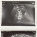 홍채떡볶이 | [임신일기👶🏻] 5-6주차 초기 임산부로 살아남기! (아기집 확인/모성보호시간/보건소 임산부 등록/입덧...