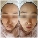 아차산피부관리 울긋불긋 민감 진정 피부케어 아차산 보라보라스킨테라피 오쏘민C+콜드 플라즈마 관리후기