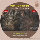 THE FORM hair | 모발이식 두피문신 병행 가이드 — 1000모·3000모·5000모 가격 비교