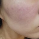 천안 여드름 흉터 전문한의원 8회차 내돈내산 후기