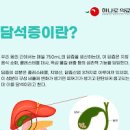 담석증 원인 및 , (통증, 수술) 이미지