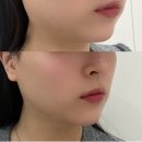 부산롯데호텔 | 부산주말피부과 온다리프팅 부산롯데호텔 피부과 솔직후기