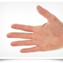 손가락대상포진 통증없는 초기증상 가려움 특징 이미지