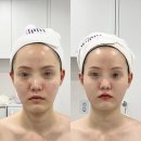 마곡 얼굴 리프팅은 여기서! 케이엠에스테틱 리얼 후기