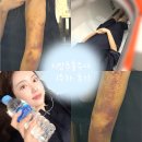 후케어 | 지방추출주사 8일차 경과｜멍·붓기 변화 과정과 고압산소케어 후관리 후기