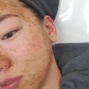 알라딘 | 부산여드름흉터 관리 연산동에스테틱 수현에스테틱 부산알라딘필링 후기