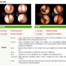 [수원 코골이 한의원] 코골이 예방 및 치료 [코골이 치료정보] 이미지