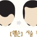 [웰슨]두피.탈모관리 시술후 후기모음5 - 홈페이지