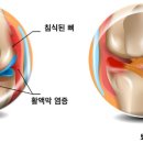 손가락 통증으로 구분하는 류마티스 vs 관절염 이미지