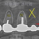 목천미소치과 네이버블로그