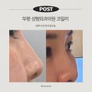 자연의원 | 부평 성형외과의원 코필러 후기 자연스러운 코라인 완성! 필러 전후 효과