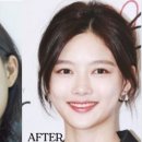 수헤어라인 이미지